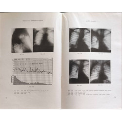 Pénicillothérapie endobronchique précise des abcès du poumon et...
